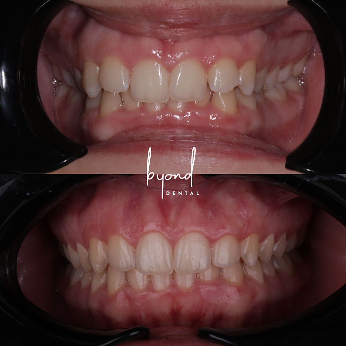 Invisalign before and after correcting deep bite and moderate teeth crowding