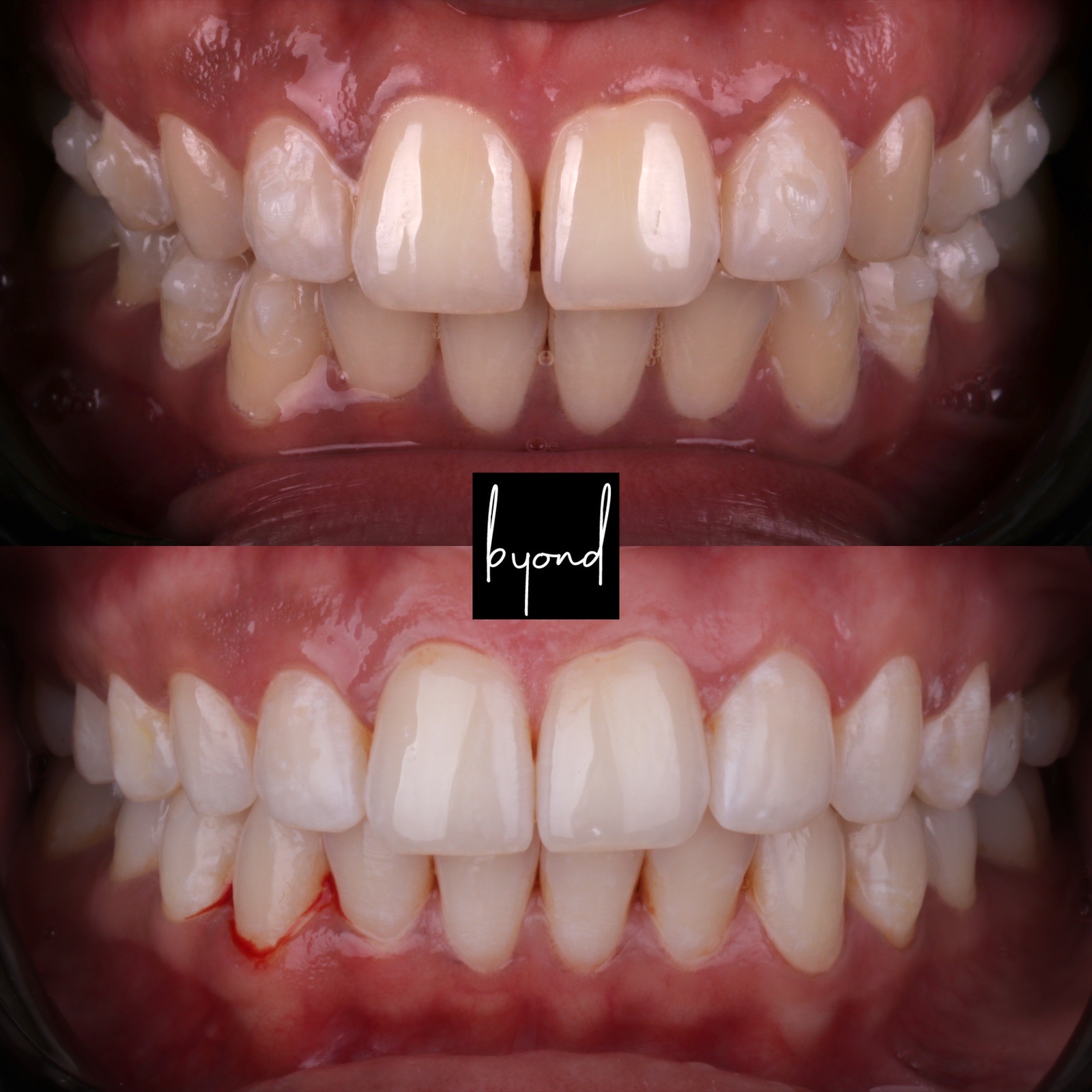invisalign before and after closing gaps between the teeth