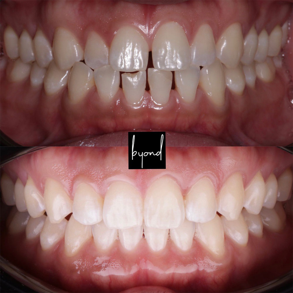 Invisalign before and after closing spaces and gaps between the front teeth