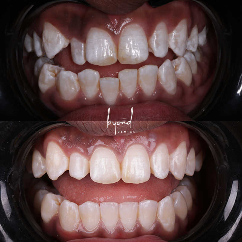 invisalign before and after moderate crowding and cross bite correction